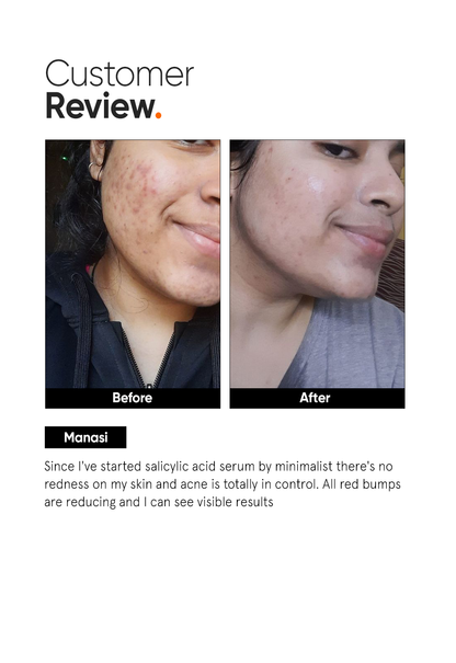 Salicylic Acid 2% Face Serum